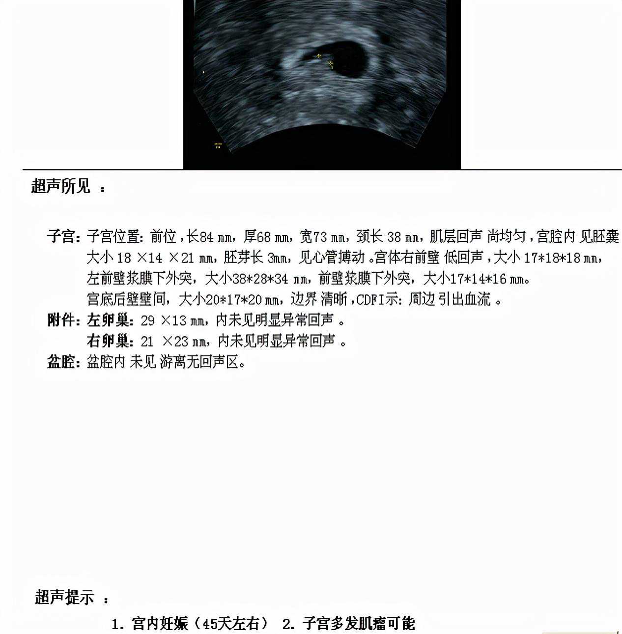 香港寄验血报告真假,内膜5mm、胚胎反复种植失败、三代试管好孕分娩，快来沾