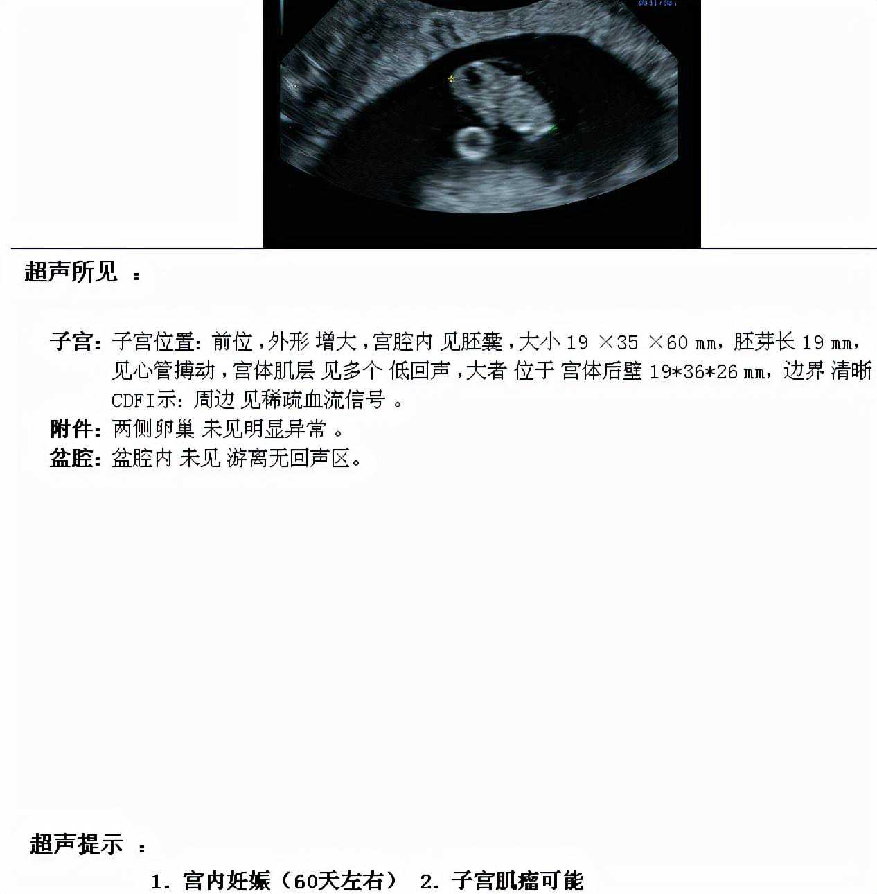 香港寄验血报告真假,内膜5mm、胚胎反复种植失败、三代试管好孕分娩，快来沾