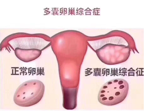 香港验血 流产后多久,多囊卵巢综合征患者如何有效备孕？
