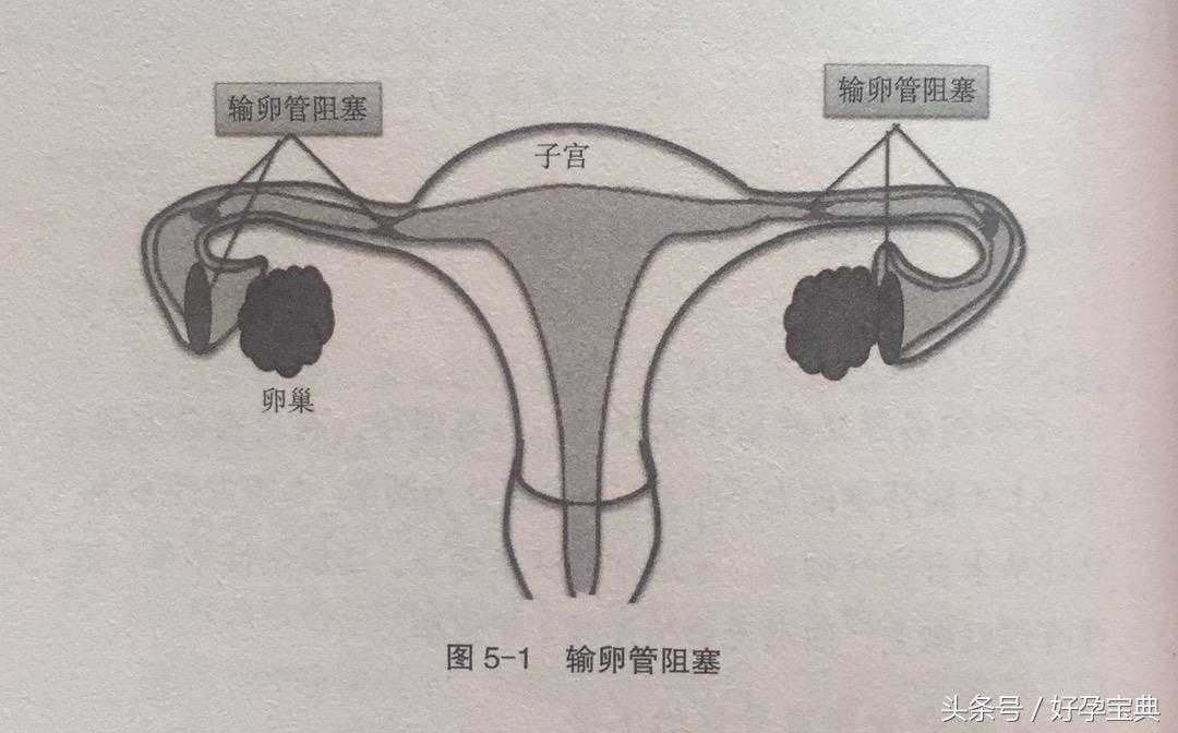 香港验血以后多少周b超,输卵管阻塞导致的不孕不育，